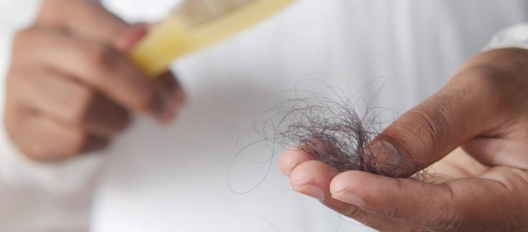 Can Hair Loss be Reversed Naturally?